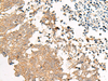 Immunohistochemistry of paraffin-embedded Human lung cancer tissue  using GPR22 Polyclonal Antibody at dilution of 1:50(×200)
