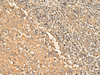 Immunohistochemistry of paraffin-embedded Human cervical cancer tissue  using RPS28 Polyclonal Antibody at dilution of 1:30(×200)