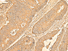 Immunohistochemistry of paraffin-embedded Human colorectal cancer tissue  using RPS28 Polyclonal Antibody at dilution of 1:30(×200)