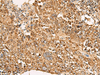 Immunohistochemistry of paraffin-embedded Human cervical cancer tissue  using ATP5I Polyclonal Antibody at dilution of 1:65(×200)