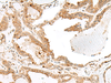 Immunohistochemistry of paraffin-embedded Human thyroid cancer tissue  using ENAH Polyclonal Antibody at dilution of 1:60(×200)