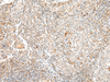 Immunohistochemistry of paraffin-embedded Human cervical cancer tissue  using TAAR2 Polyclonal Antibody at dilution of 1:40(×200)