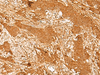 Immunohistochemistry of paraffin-embedded Human ovarian cancer tissue  using GTF3C3 Polyclonal Antibody at dilution of 1:30(×200)