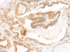 Immunohistochemistry of paraffin-embedded Human thyroid cancer tissue  using HEBP1 Polyclonal Antibody at dilution of 1:60(×200)