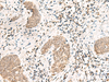 Immunohistochemistry of paraffin-embedded Human esophagus cancer tissue  using SNRPG Polyclonal Antibody at dilution of 1:40(×200)