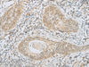 Immunohistochemistry of paraffin-embedded Human esophagus cancer tissue  using HELT Polyclonal Antibody at dilution of 1:40(×200)