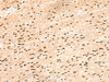 Immunohistochemistry of paraffin-embedded Human colorectal cancer tissue  using HIST1H1D Polyclonal Antibody at dilution of 1:55(×200)