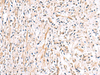 Immunohistochemistry of paraffin-embedded Human prost ate cancer tissue  using HLA-DOB Polyclonal Antibody at dilution of 1:40(×200)