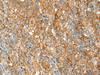 Immunohistochemistry of paraffin-embedded Human cervical cancer tissue  using HLA-DRB1 Polyclonal Antibody at dilution of 1:35(×200)