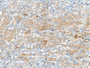 Immunohistochemistry of paraffin-embedded Human cervical cancer tissue  using HLA-DRB3 Polyclonal Antibody at dilution of 1:50(×200)