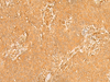 Immunohistochemistry of paraffin-embedded Human breast cancer tissue  using KRT76 Polyclonal Antibody at dilution of 1:50(×200)