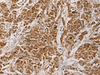 Immunohistochemistry of paraffin-embedded Human colorectal cancer tissue  using HOXC5 Polyclonal Antibody at dilution of 1:55(×200)