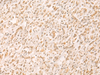 Immunohistochemistry of paraffin-embedded Human gastric cancer tissue  using SETD1A Polyclonal Antibody at dilution of 1:25(×200)