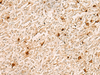 Immunohistochemistry of paraffin-embedded Human gastric cancer tissue  using TBCK Polyclonal Antibody at dilution of 1:25(×200)