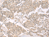 Immunohistochemistry of paraffin-embedded Human lung cancer tissue  using RRP8 Polyclonal Antibody at dilution of 1:50(×200)