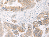 Immunohistochemistry of paraffin-embedded Human colorectal cancer tissue  using IDUA Polyclonal Antibody at dilution of 1:35(×200)