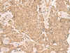 Immunohistochemistry of paraffin-embedded Human lung cancer tissue  using IL1RAPL2 Polyclonal Antibody at dilution of 1:25(×200)