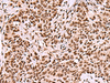 Immunohistochemistry of paraffin-embedded Human ovarian cancer tissue  using FOXK2 Polyclonal Antibody at dilution of 1:50(×200)