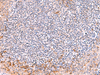 Immunohistochemistry of paraffin-embedded Human tonsil tissue  using ITSN2 Polyclonal Antibody at dilution of 1:40(×200)