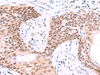 Immunohistochemistry of paraffin-embedded Human esophagus cancer tissue  using IRF2BP1 Polyclonal Antibody at dilution of 1:40(×200)