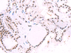 Immunohistochemistry of paraffin-embedded Human thyroid cancer tissue  using IRF2BP1 Polyclonal Antibody at dilution of 1:40(×200)