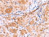 Immunohistochemistry of paraffin-embedded Human liver cancer tissue  using IRGC Polyclonal Antibody at dilution of 1:30(×200)