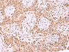 Immunohistochemistry of paraffin-embedded Human ovarian cancer tissue  using IRX1 Polyclonal Antibody at dilution of 1:35(×200)