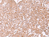 Immunohistochemistry of paraffin-embedded Human ovarian cancer tissue  using IRX2 Polyclonal Antibody at dilution of 1:45(×200)