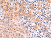 Immunohistochemistry of paraffin-embedded Human liver cancer tissue  using ITGA11 Polyclonal Antibody at dilution of 1:75(×200)