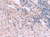 Immunohistochemistry of paraffin-embedded Human liver cancer tissue  using NMRK2 Polyclonal Antibody at dilution of 1:55(×200)