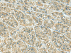 Immunohistochemistry of paraffin-embedded Human liver cancer tissue  using JPH1 Polyclonal Antibody at dilution of 1:30(×200)