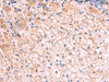 Immunohistochemistry of paraffin-embedded Human liver cancer tissue  using KLK9 Polyclonal Antibody at dilution of 1:50(×200)