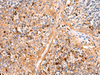 Immunohistochemistry of paraffin-embedded Human liver cancer tissue  using KANSL1L Polyclonal Antibody at dilution of 1:40(×200)