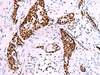 Immunohistochemistry of paraffin-embedded Human esophagus cancer tissue  using TRIM28(phospho-Ser824) Polyclonal Antibody at dilution of 1:50(×200)