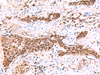 Immunohistochemistry of paraffin-embedded Human esophagus cancer tissue  using SOX2 Polyclonal Antibody at dilution of 1:35(×200)