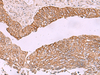 Immunohistochemistry of paraffin-embedded Human lung cancer tissue  using KCNK12 Polyclonal Antibody at dilution of 1:60(×200)