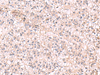Immunohistochemistry of paraffin-embedded Human liver cancer tissue  using KCNK18 Polyclonal Antibody at dilution of 1:75(×200)