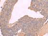 Immunohistochemistry of paraffin-embedded Human liver cancer tissue  using KCNN2 Polyclonal Antibody at dilution of 1:65(×200)