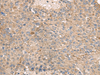 Immunohistochemistry of paraffin-embedded Human liver cancer tissue  using ABCA10 Polyclonal Antibody at dilution of 1:50(×200)