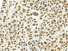 Immunohistochemistry of paraffin-embedded Human esophagus cancer tissue  using KHSRP Polyclonal Antibody at dilution of 1:50(×200)