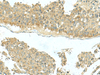Immunohistochemistry of paraffin-embedded Human liver cancer tissue  using KIR2DL5A Polyclonal Antibody at dilution of 1:40(×200)