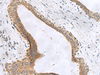 Immunohistochemistry of paraffin-embedded Human breast cancer tissue  using CEMIP Polyclonal Antibody at dilution of 1:120(×200)