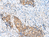 Immunohistochemistry of paraffin-embedded Human cervical cancer tissue  using CAMSAP3 Polyclonal Antibody at dilution of 1:110(×200)