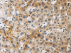 Immunohistochemistry of paraffin-embedded Human liver cancer tissue  using PLIN4 Polyclonal Antibody at dilution of 1:50(×200)