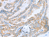 Immunohistochemistry of paraffin-embedded Human thyroid cancer tissue  using KIF5A Polyclonal Antibody at dilution of 1:30(×200)