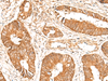 Immunohistochemistry of paraffin-embedded Human colorectal cancer tissue  using BAG3 Polyclonal Antibody at dilution of 1:35(×200)