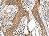 Immunohistochemistry of paraffin-embedded Human esophagus cancer tissue  using TTR Polyclonal Antibody at dilution of 1:50(×200)