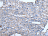 Immunohistochemistry of paraffin-embedded Human lung cancer tissue  using GJA1 Polyclonal Antibody at dilution of 1:50(×200)