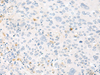 Immunohistochemistry of paraffin-embedded Human cervical cancer tissue  using FABP4 Polyclonal Antibody at dilution of 1:60(×200)