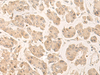 Immunohistochemistry of paraffin-embedded Human gastric cancer tissue  using FABP4 Polyclonal Antibody at dilution of 1:60(×200)